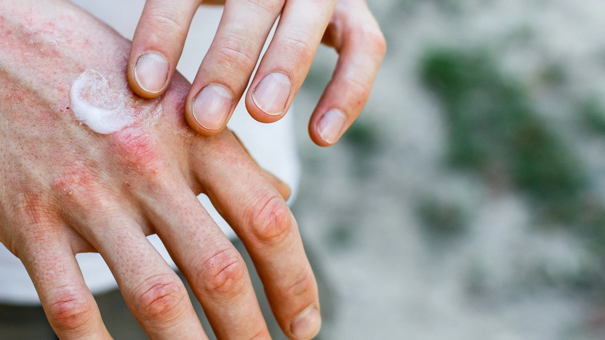 7 Langkah Mencegah Tangan Kering dan Pecah-Pecah